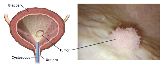 Best bladder cancer specialist in Mumbai