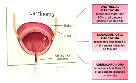 Bladder tumor diagnosis