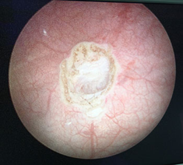 bladder cancer treatment in Mumbai