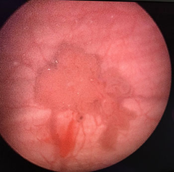 Bladder cancer specialist in Mumbai