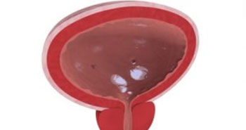 Bladder stones Treatment In Mumbai - Leading Urologist Mumbai