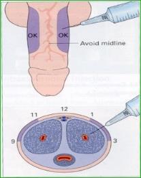 ED treatment in Mumbai