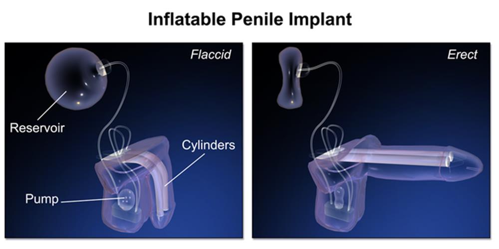 Erectile dysfunction treatment in Mumbai