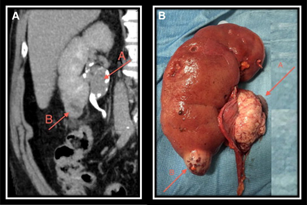 Renal cancer expert in Mumbai- Dr. Dilip raja