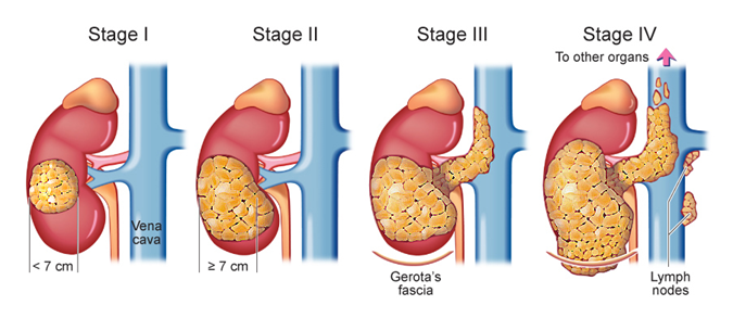 kidney cancer diagnosis and treatment - early stage