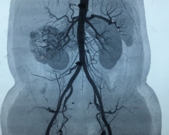 Best doctor for kidney cancer treatment in Mumbai