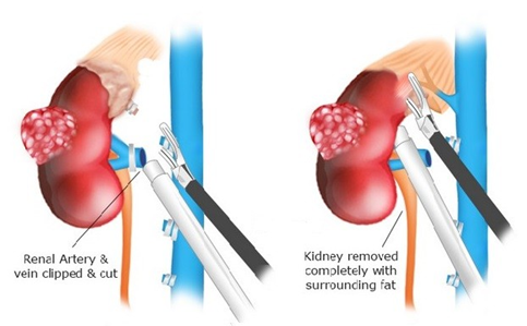 kidney tumor removal surgery by the best Urologist in Mumbai