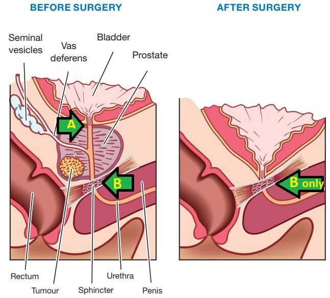 Treatments of prostate cancer In Mumbai