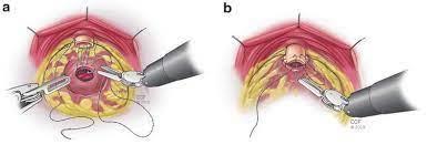 radical prostatectomy- Prostate Cancer treatment Mumbai