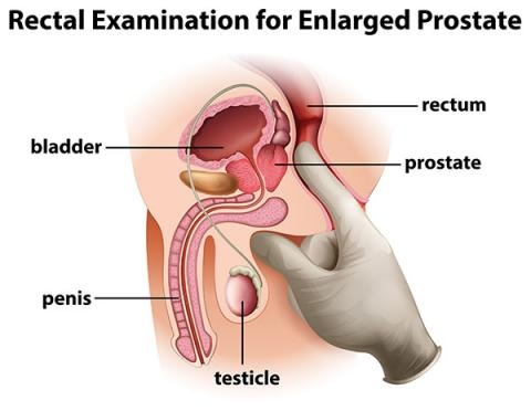 Enlarged prostate symptoms & its treatment by Best Urologist for BPH Mumbai