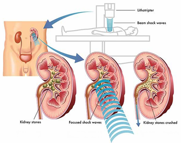 Kidney stone removal by laser treatment in mumbai by best kidney urologist for kidney stone in Mumbai