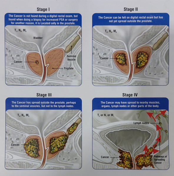 prostate cancer Stages Explained By Best Urologist In Mumbai - dr. Dilip Raja