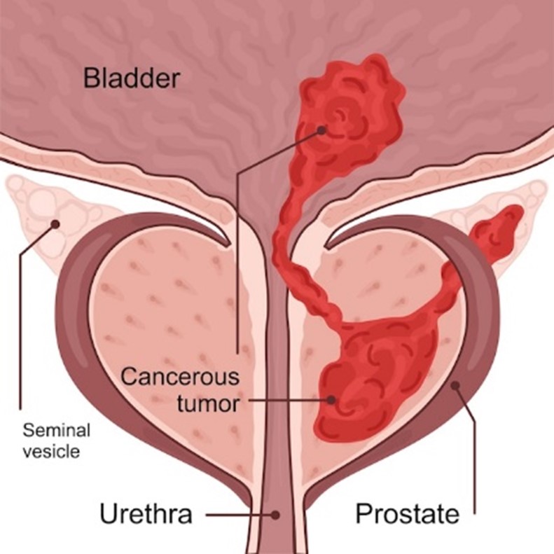 prostate cancer treatment in Mumbai