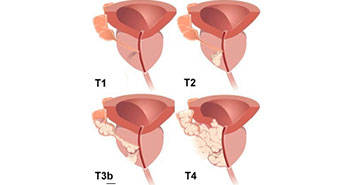 Prostate cancer | Best Urologist in Mumbai