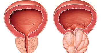 Prostate enlargement BPH treatment in mumbai, Top Urologist in Mumbai