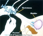 Prostate enlargement treatment in Mumbai - TURP & Laser therapy