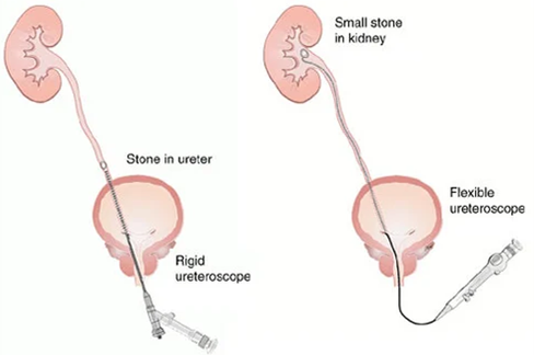 Ureteric stone treatment in Mumbai