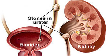 Ureteric stones Treatement in Mumbai Top Urologist in Mumbai