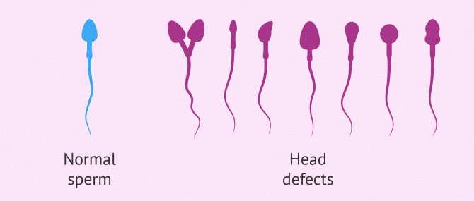 male infertility causes
