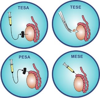 Male infertility doctor in mumbai
