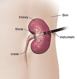 Kidney stone removal in Mumbai explained by Dr.dilip Raja best urologist in mumbai