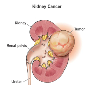 Best doctor for kidney cancer Mumbai