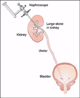 Kidney Stone Treatment in mumbai