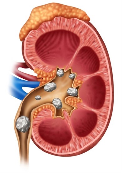 Kidney stone treatment in Mumbai by Best Urologist in Mumbai