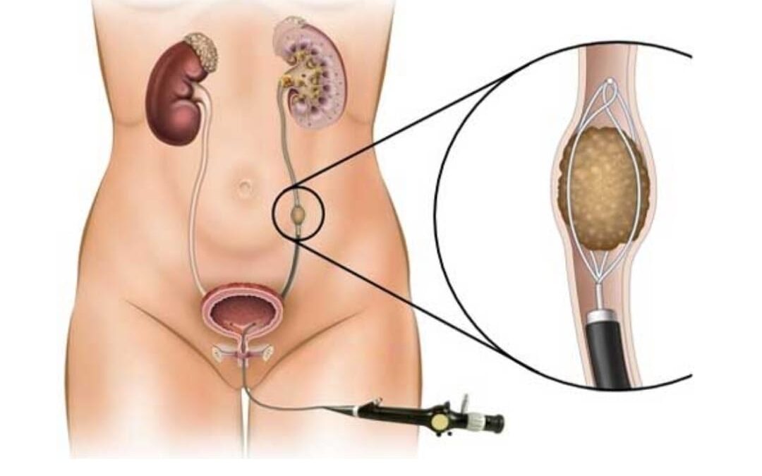 best Doctor for Ureteric stone treatment in Mumbai explaining the procedure of ureteric stone removal
