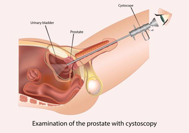 Best non surgical BPH Prostate enlargement treatment in Mumbai
