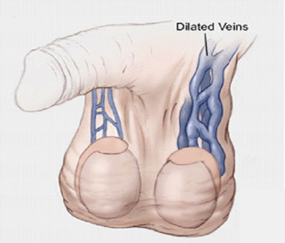 common symptoms of varicocele, scrotal pain, swelling ,and infertility, explained by leading Urologist in Mumbai