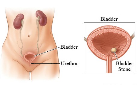 Laser Bladder Stone removal Mumbai