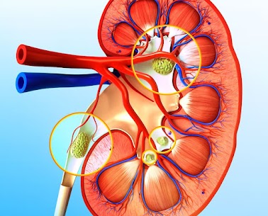 kidney stone treatment Mumbai